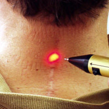 Laser Treatment