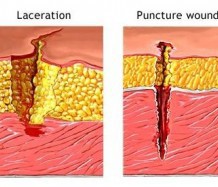 Puncture Wounds Scars